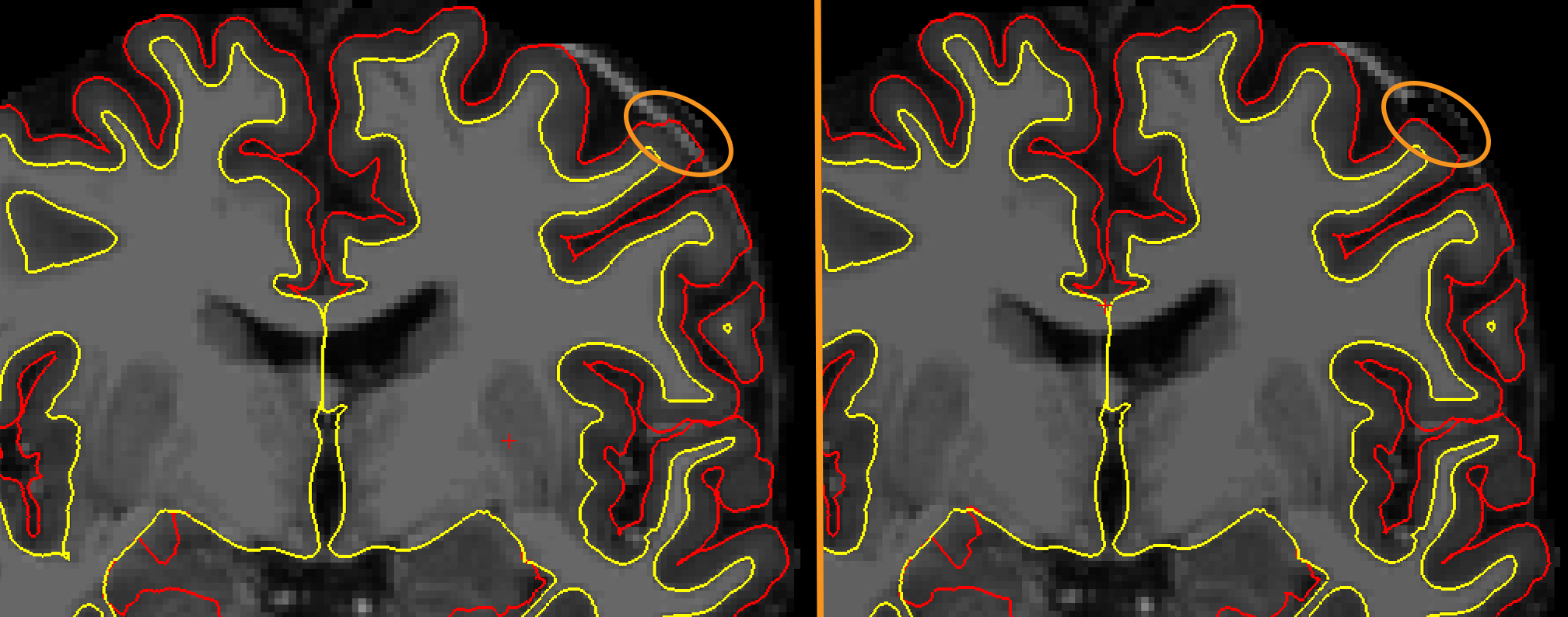 ../_images/13_PialSurface_Edit_Before_After.png