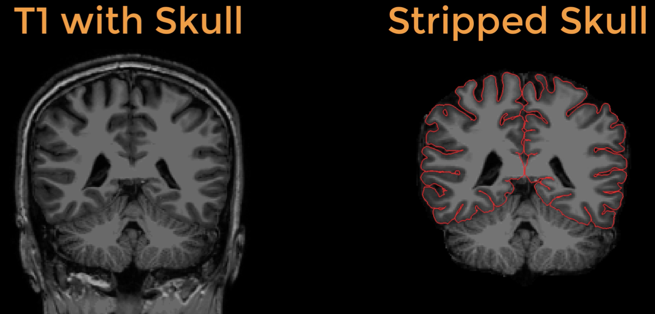 ../_images/13_SkullStripping_BeforeAfter.png